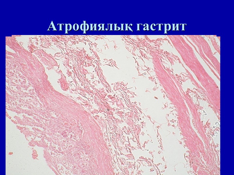 Атрофиялық гастрит